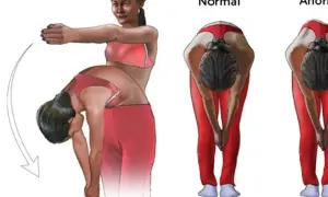 Ilustración de ejercicios para escoliosis: una chica se inclina, mostrando la diferencia entre una espalda normal y una anormal.