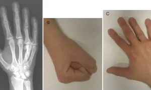 Radiografía de mano (A) mostrando un hueso metacarpiano fracturado, un puño cerrado (B) y una mano abierta (C).