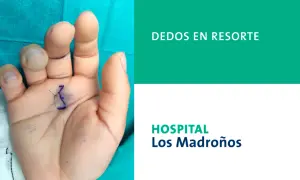 Mano con marca para cirugía de dedo en resorte. Ecografía muestra la mano de un paciente con marcas quirúrgicas en la palma y los dedos, indicando el tratamiento para el dedo en resorte.