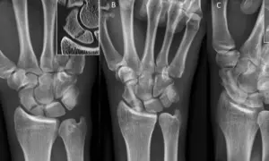 Radiografías de mano que muestran el escafoides. La imagen A es una vista anteroposterior, B una vista lateral y C una vista oblicua.