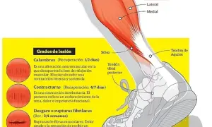 Ilustración de la anatomía de la pierna, detallando el músculo sóleo y los grados de lesión muscular, como desgarros.