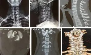 Radiografías y tomografías de columna cervical, mostrando la apófisis odontoides y posibles fracturas.
