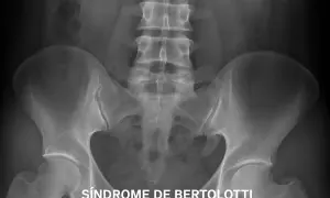 Radiografía pélvica que muestra la sacralización de L5, una anomalía vertebral que puede causar dolor lumbar.
