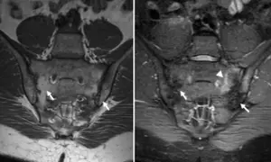 Resonancia sacroiliaca: imagen (a) muestra hallazgos normales, mientras que (b) revela inflamación y edema en la articulación sacroiliaca izquierda (flechas y triángulo).