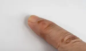 Un dedo con bolitas en los dedos de las manos, posiblemente una ampolla o un callo.