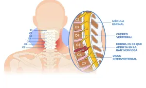 Ilustración de la columna cervical con hernia C5-C6 que causa cervicobraquialgia derecha.