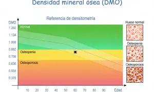 Gráfico de densitometría ósea que muestra la relación entre DMO y edad, con zonas de normalidad, osteopenia y osteoporosis.