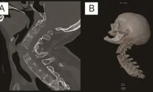 Corte sagital y reconstrucción 3D de columna cervical mostrando una grave fractura cervical.