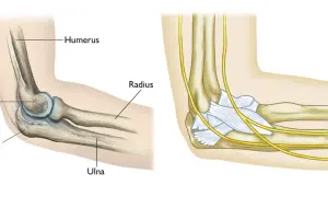 Ilustración anatómica del codo, mostrando el húmero, radio, cúbito y olecranon. La imagen de la derecha detalla nervios y ligamentos, útil para entender una fractura olecranon.