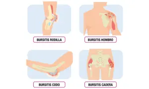 Ilustraciones de bursitis en rodilla, hombro, codo y cadera, mostrando inflamación en las articulaciones.