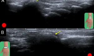 Ecografía muestra un carpal boss, una protuberancia ósea en la muñeca, con flechas señalando la zona afectada.