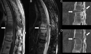 Resonancia magnética y tomografía de columna vertebral. La resonancia muestra cambios degenerativos, indicativos de artrosis lumbar.