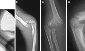 Radiografías de codo muestran una fractura supracondilea con desplazamiento y fragmentación ósea, indicando una lesión compleja.