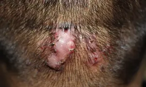 Un bulto en la nuca con varias lesiones rosadas y costras, rodeado de cabello oscuro.