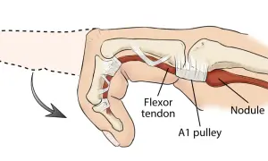 Anatomía del dedo en gatillo: un tendón flexor engrosado y un nódulo impiden el movimiento suave a través de la polea A1.
