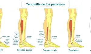 Ilustración de la anatomía del tobillo y la pierna, mostrando el tendón peroneo lateral largo y la tendinitis.