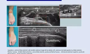 Ecografía del tobillo: muestra tendones extensores, arteria y vena tibial anterior, y el nervio peroneo profundo.
