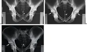 Radiografía de cadera que muestra mediciones y fijaciones. La imagen A compara la distancia 'a'. La imagen B muestra la distancia 'a'' y la flecha indica un implante. La imagen C muestra la distancia 'b' y una flecha señala un implante.