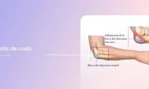 Ilustración de la bursitis de codo, mostrando la inflamación de la bursa del olécranon.