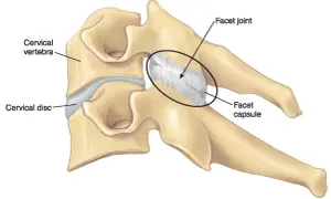 Ilustración de vértebras cervicales y disco, destacando la articulación facetaria y su cápsula, relevante para entender la sinovitis facetaria.
