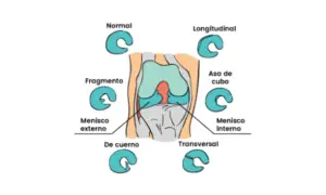 Ilustración de rodilla con diferentes tipos de lesiones meniscales, incluyendo el cuerno posterior del menisco interno.