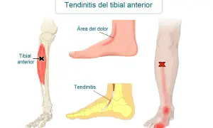 Ilustración médica que muestra la tendinitis tibial anterior, con el músculo tibial anterior marcado y áreas de dolor en el pie y la espinilla.