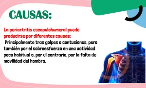 Causas de la periartritis escapulohumeral: golpes, contusiones, sobreesfuerzo o falta de movilidad del hombro. Ilustración de un hombro con dolor.
