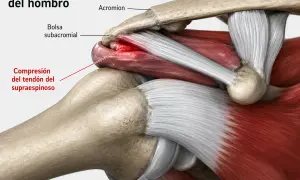 Ilustración anatómica del **impingement subacromial** en el hombro, mostrando la compresión del tendón del supraespinoso.
