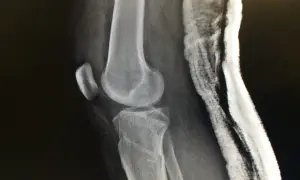 Radiografía de rodilla con fractura de meseta tibial, indicando el grado de discapacidad.