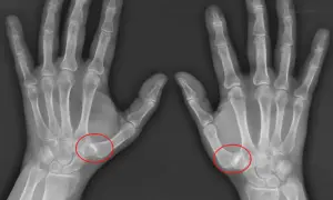 Radiografías de ambas manos mostrando rizartrosis grados avanzados en la base del pulgar, con deformidad ósea y estrechamiento articular.