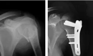 Radiografía muestra fractura humero proximal antes y después de la cirugía con placa y tornillos.