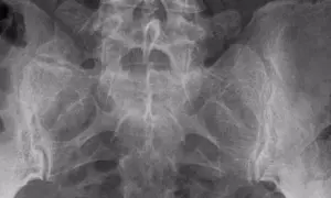 Radiografía de pelvis y columna lumbar. Se observan cambios degenerativos y esclerosis en la apófisis transversa.