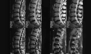 Imágenes de resonancia magnética de la rm columna dorsal, mostrando vértebras y discos intervertebrales.