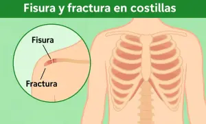 Ilustración muestra una costilla rota, con un primer plano de una fisura y una fractura en una costilla.