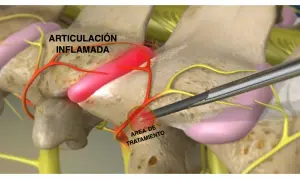 Ilustración de articulación interapofisaria inflamada y su tratamiento.