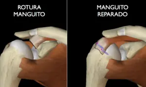 Comparación de un manguito rotador roto con uno reparado, mostrando cómo el manguito rotador se cura solo.