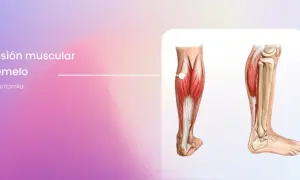 Ilustración anatómica de la pantorrilla, mostrando la distensión muscular del gemelo y el dolor asociado en la pierna.