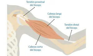 Anatomía del bíceps, mostrando tendón proximal, cabeza larga y corta, y tendón distal. Ilustra la zona donde puede ocurrir una rotura de bíceps.