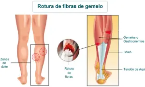 Ilustración de las secuelas de rotura fibrilar gemelo, mostrando zonas de dolor y detalle de la rotura.