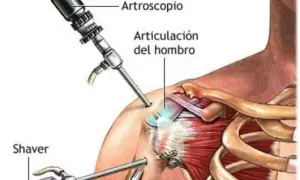 Ilustración de artroscopia de hombro para tratar una luxación glenohumeral. Se ven un artroscopio y un shaver.