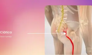 Ilustración de ciática, mostrando dolor lumbar derecho irradiado hacia adelante a lo largo del nervio ciático.