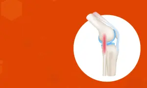 Ilustración de rodilla con tendinitis en el ligamento lateral externo, marcada en rojo.