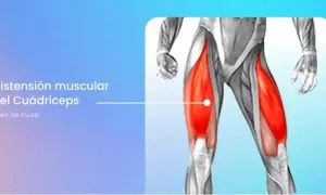 Anatomía del cuádriceps con el vasto interno inflamado, indicando dolor de muslo.
