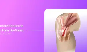 Ilustración de la tendinopatía de la pata de ganso en la rodilla, mostrando la inflamación y el dolor. La recuperación es clave.