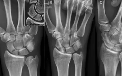 Radiografías de mano que muestran el escafoides. La imagen A es una vista anteroposterior, B una vista lateral y C una vista oblicua.