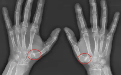 Radiografías de ambas manos mostrando rizartrosis grados avanzados en la base del pulgar, con deformidad ósea y estrechamiento articular.