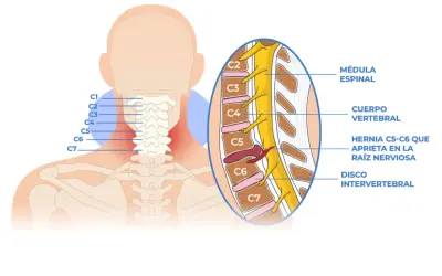 Ilustración de la columna cervical mostrando un pinzamiento cervical C5-C6 que comprime una raíz nerviosa.