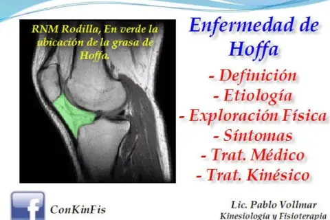 RM de rodilla que muestra la grasa de Hoffa en verde. Enfermedad de Hoffa: definición, etiología, exploración, síntomas y tratamiento.