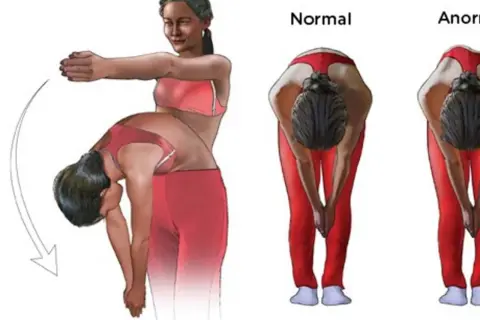 Ilustración de ejercicios para escoliosis: una chica se inclina, mostrando la diferencia entre una espalda normal y una anormal.