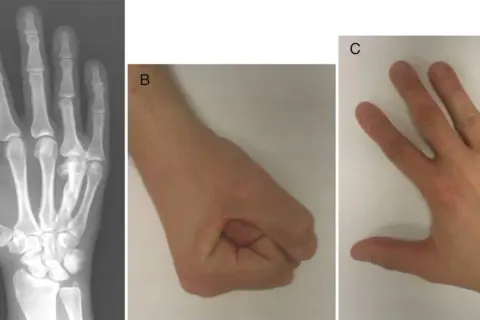 Radiografía de mano (A) mostrando un hueso metacarpiano fracturado, un puño cerrado (B) y una mano abierta (C).